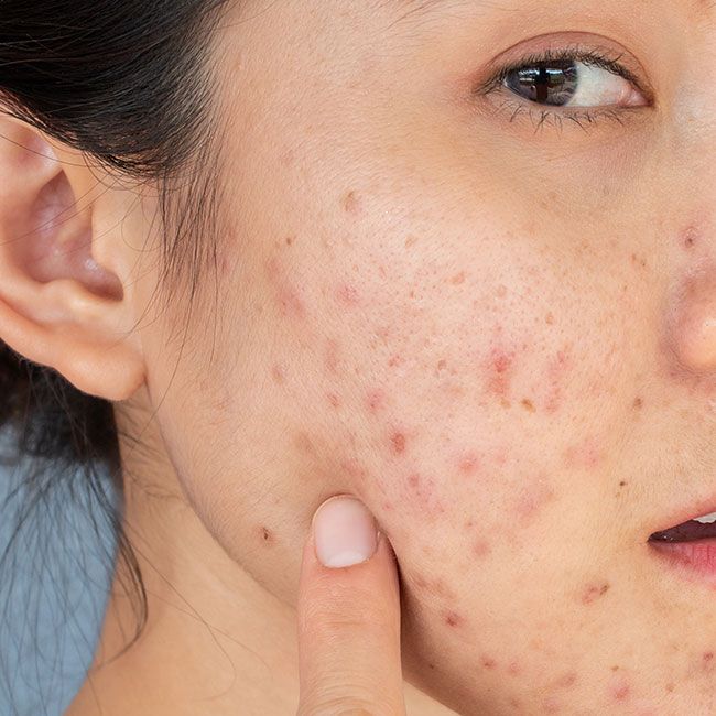 Why Your Skin Breaks Out More During the Holidays (And How to Prevent It)